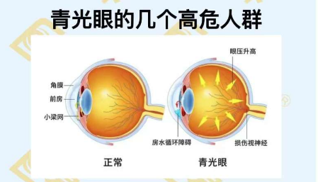 青光眼的幾個(gè)高危人群？