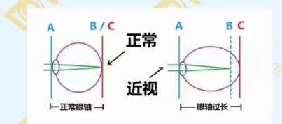 哪個(gè)年齡近視度數最容易增長(cháng)？