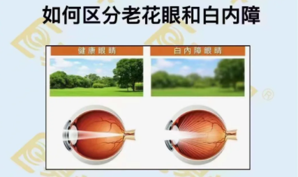 如何區分老花眼和白內障？