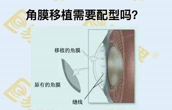 角膜移植需要配型嗎？